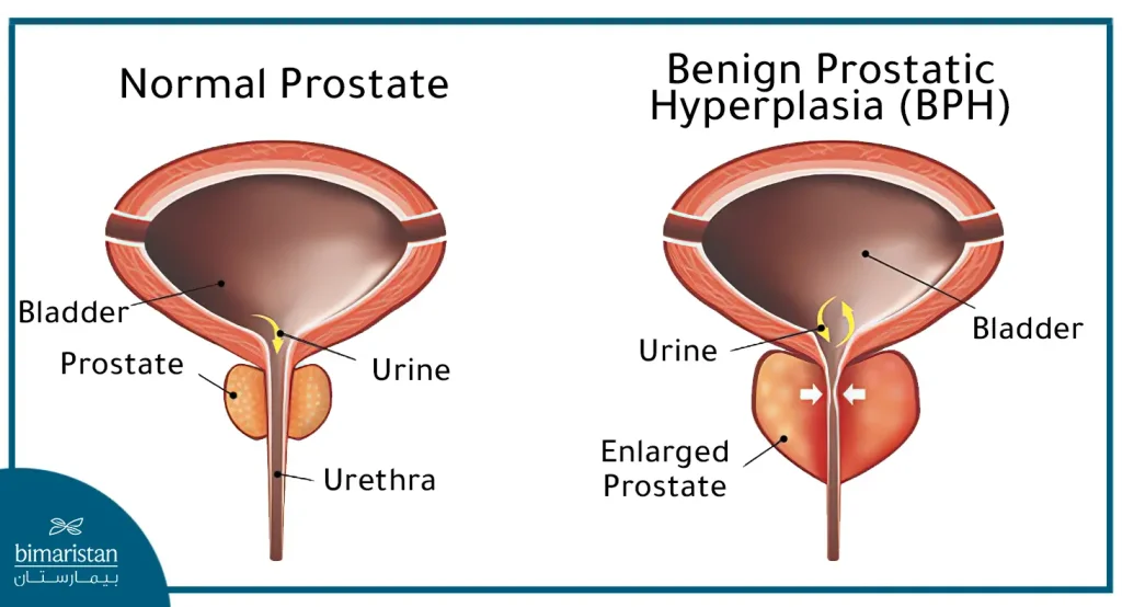 The Difference Between Benign Prostatic Hyperplasia And Normal Prostate