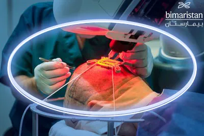 How To Perform A Robotic Hair Replacement In Turkey.