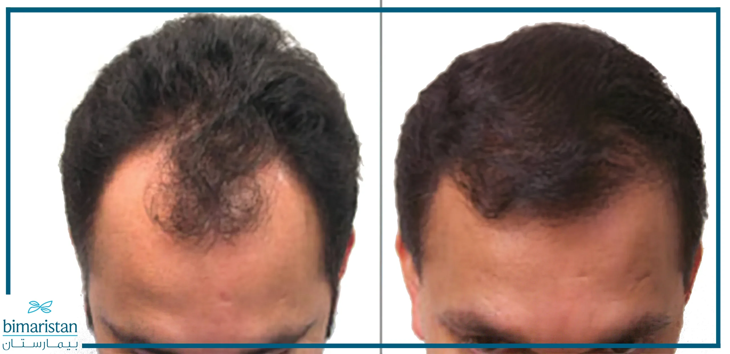 A Picture Of A Hair Transplantation Patient Before And After Undergoing A Robotic Hair Surgery.