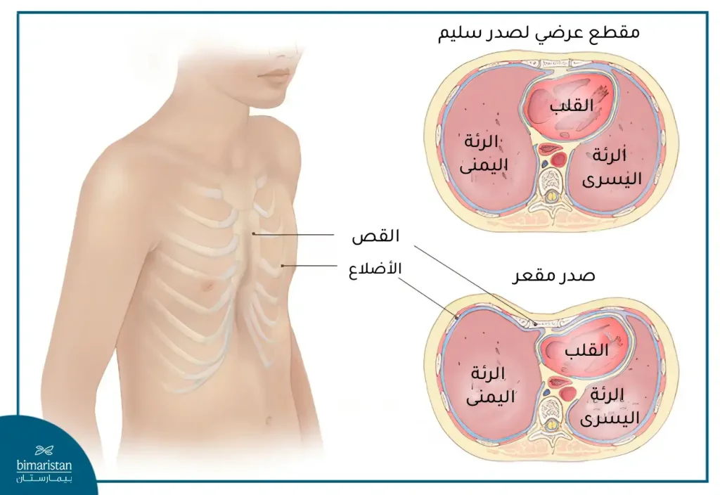 مقارنة بين شكل القفص الصدري الطبيعي وشكل تقعر القفص الصدري - تشوه القفص الصدري بالصور