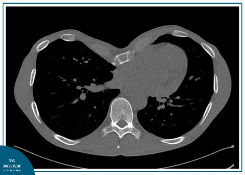 تشخيص التقعر الصدري في تركيا عبر التصوير الطبقي المحوري
