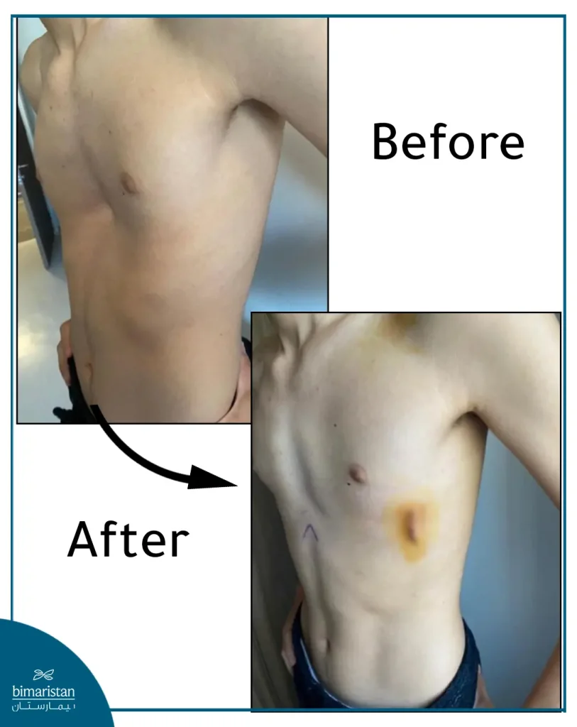 Before And After Pectus Excavatum Surgery