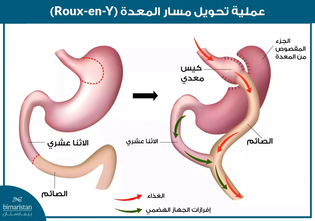 شكل المعدة والأمعاء بعد عملية تحويل مسار المعدة Roux-En-Y