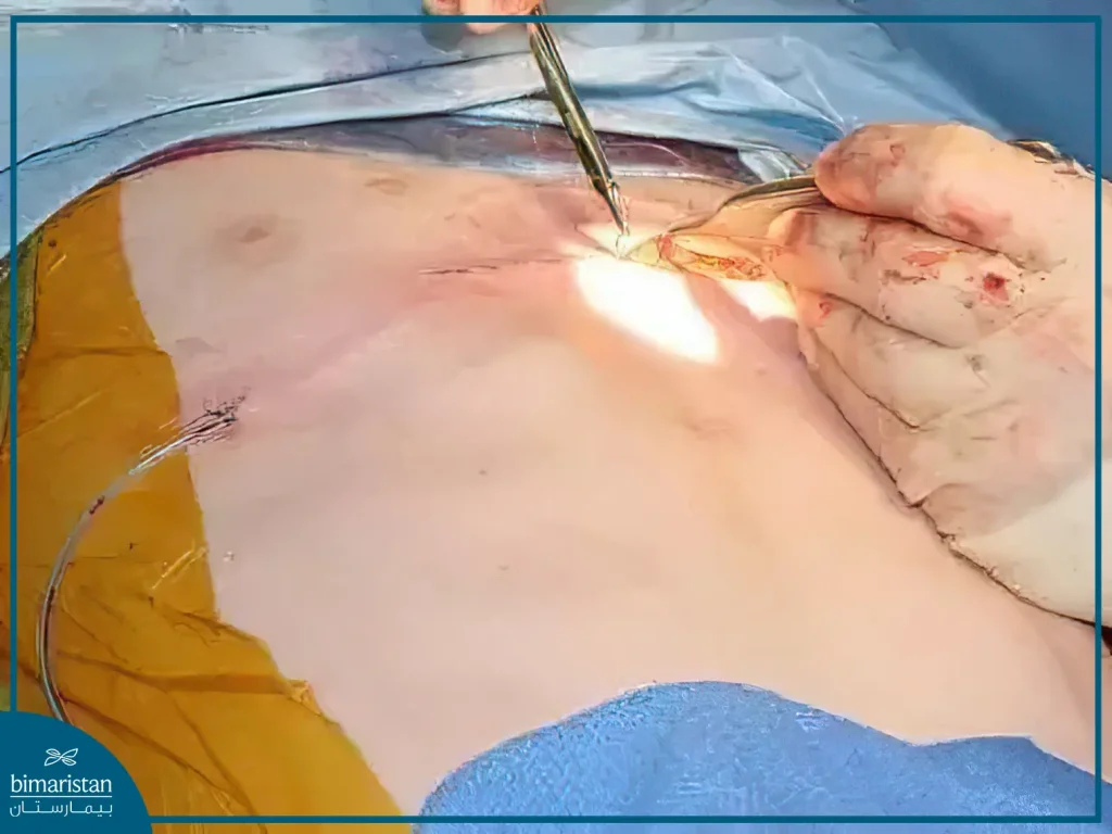 علاج صدر الحمامة بالجراحة في تركيا