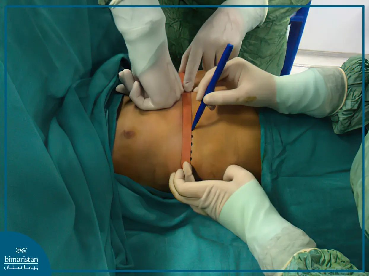 Treatment Of Pectus Carinatum In Turkey Through The Abramson Procedure