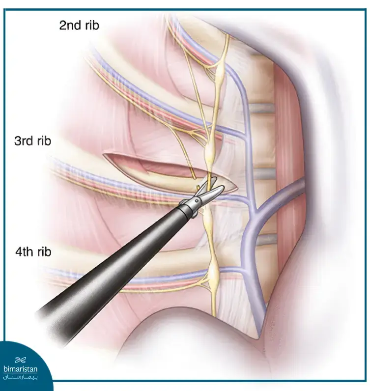 Sympathetic Nerve Block Surgery In Turkey - A Permanent Treatment For Excessive Sweating