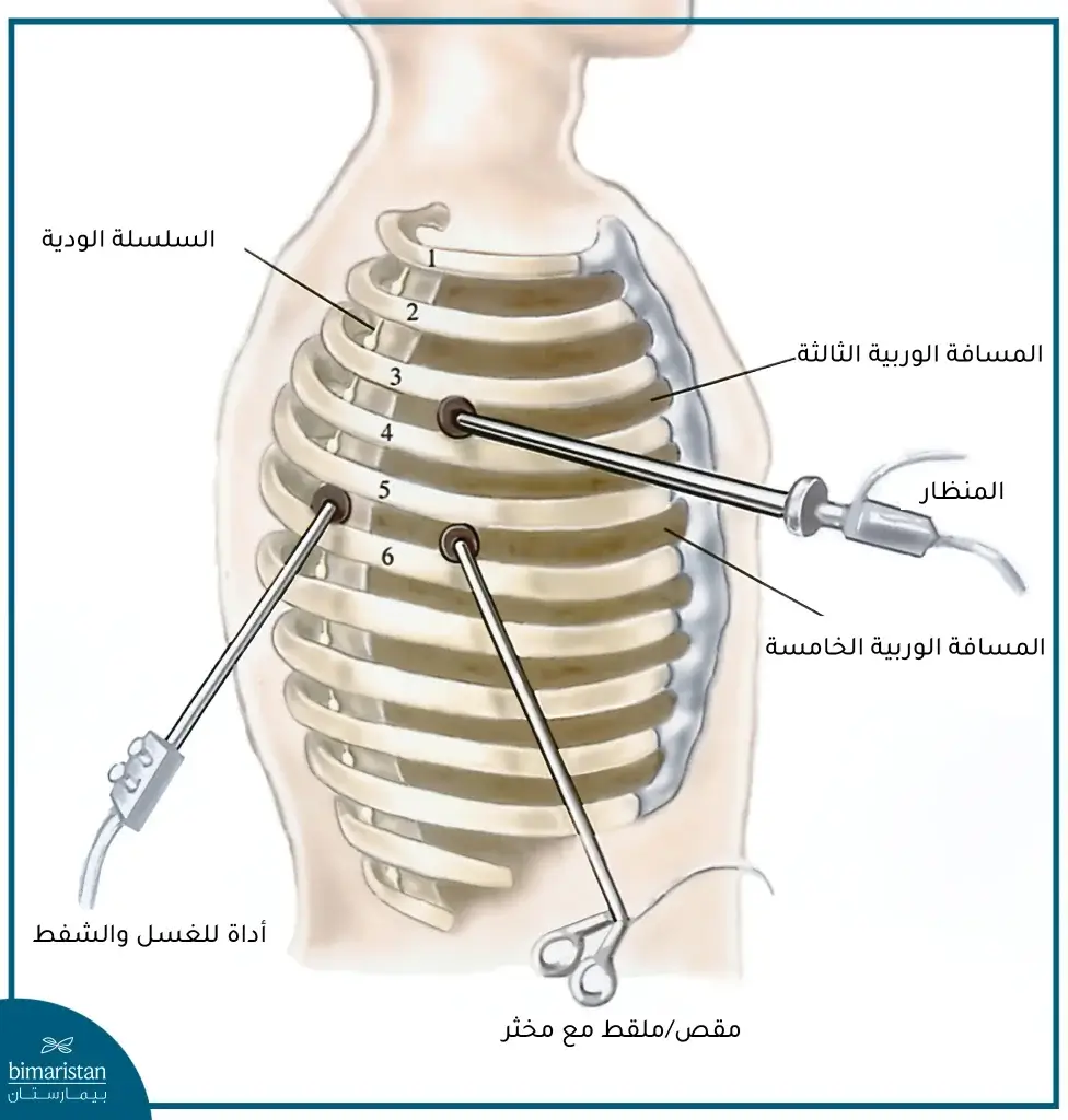 جراحة قطع الودي الصدري بالمنظار في تركيا