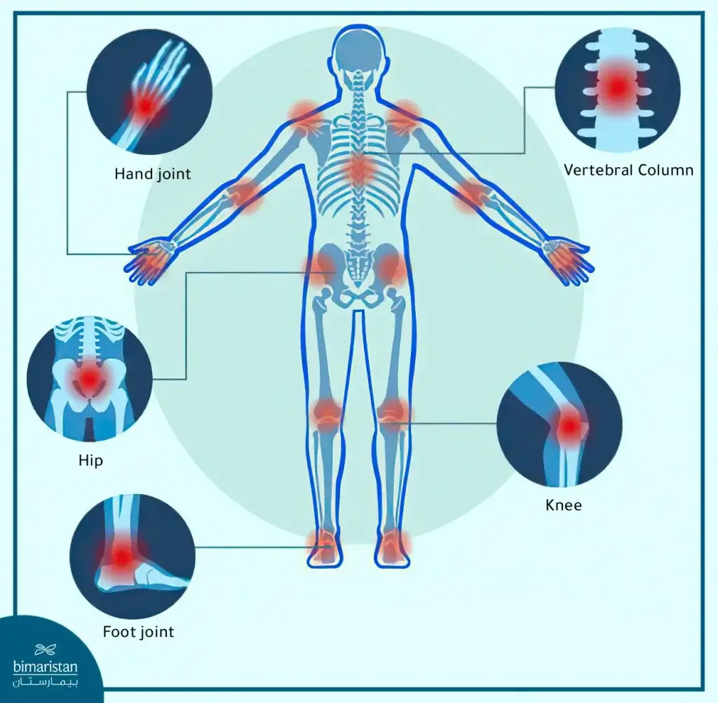 Common Joints Affected By Rheumatoid Arthritis