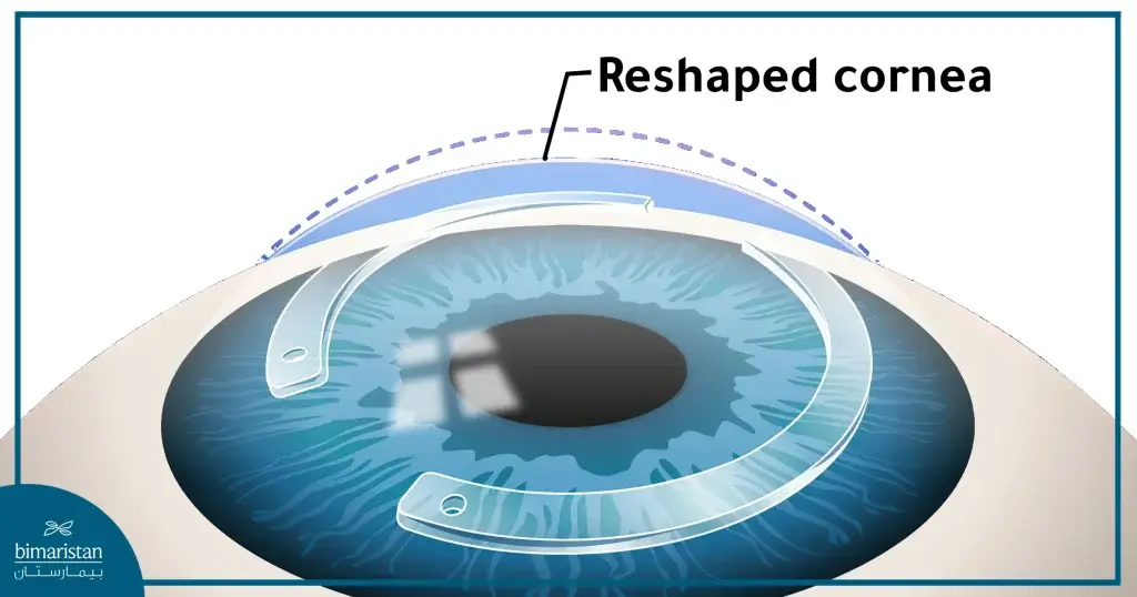 
We Notice The Crescent-Shaped Plastic Pieces To Reshape The Surface Of The Cornea.