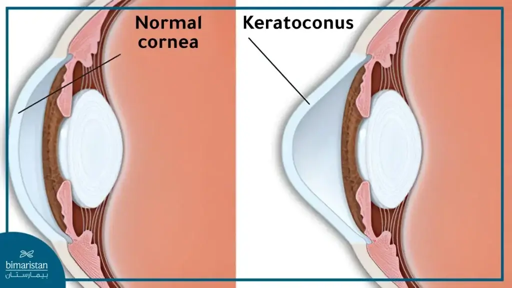 We Notice That The Shape Of The Keratoconus Changes From Curvature To Dome.