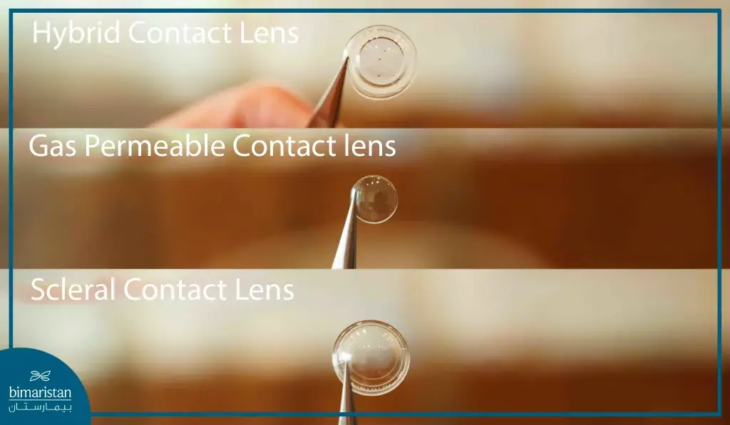 The Picture Shows The Three Types Of Contact Lenses Used To Treat Keratoconus.