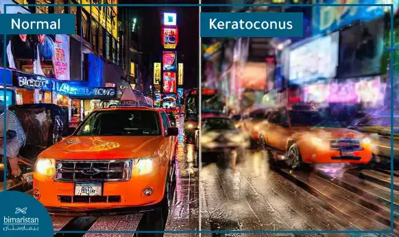 The Difference In Vision Between The Normal Cornea And Keratoconus, Where We Notice Blurring And Distortion