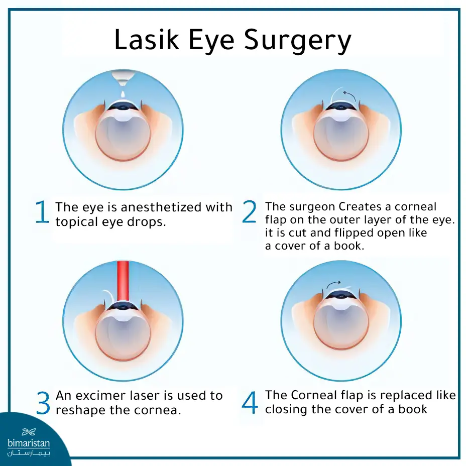 Lasik Eye Surgery