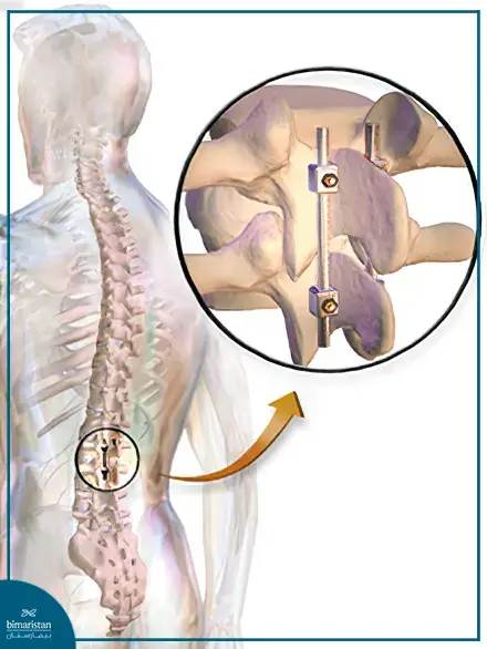 Harrington Rods Used In Spinal Fusion Surgeries