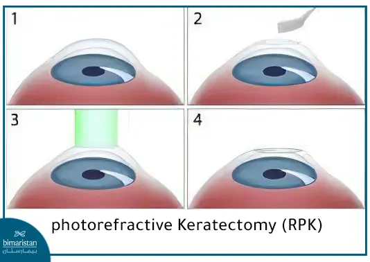 Photorefractive Keratectomy To Treat Myopia
