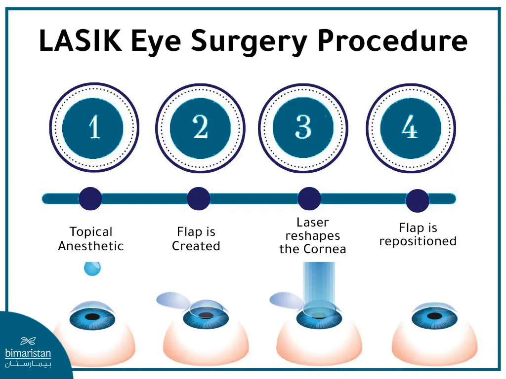 Stages Of The Lasek Procedure To Treat Myopia 