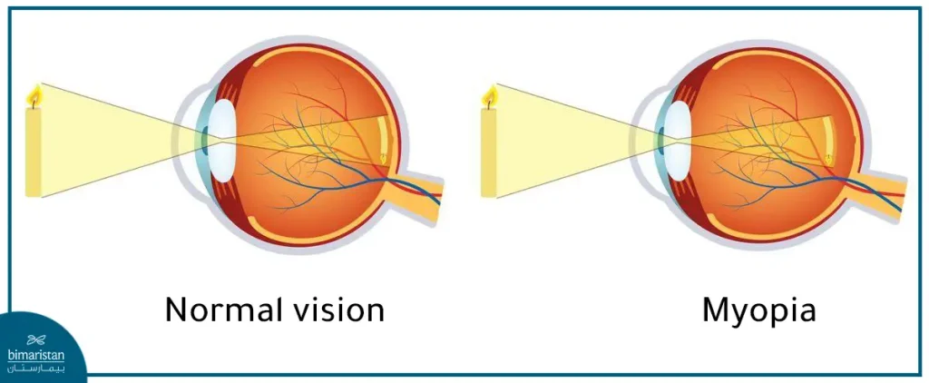 The Difference Between Nearsightedness And Normal Vision 