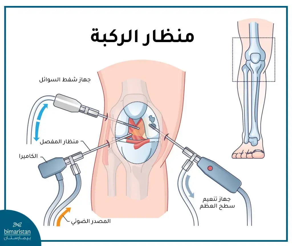 استبدال مفصل الركبة بواسطة المنظار