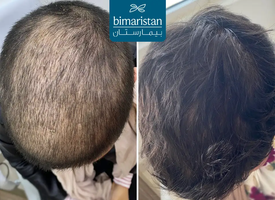 Hair Transplant Customer Picture 1