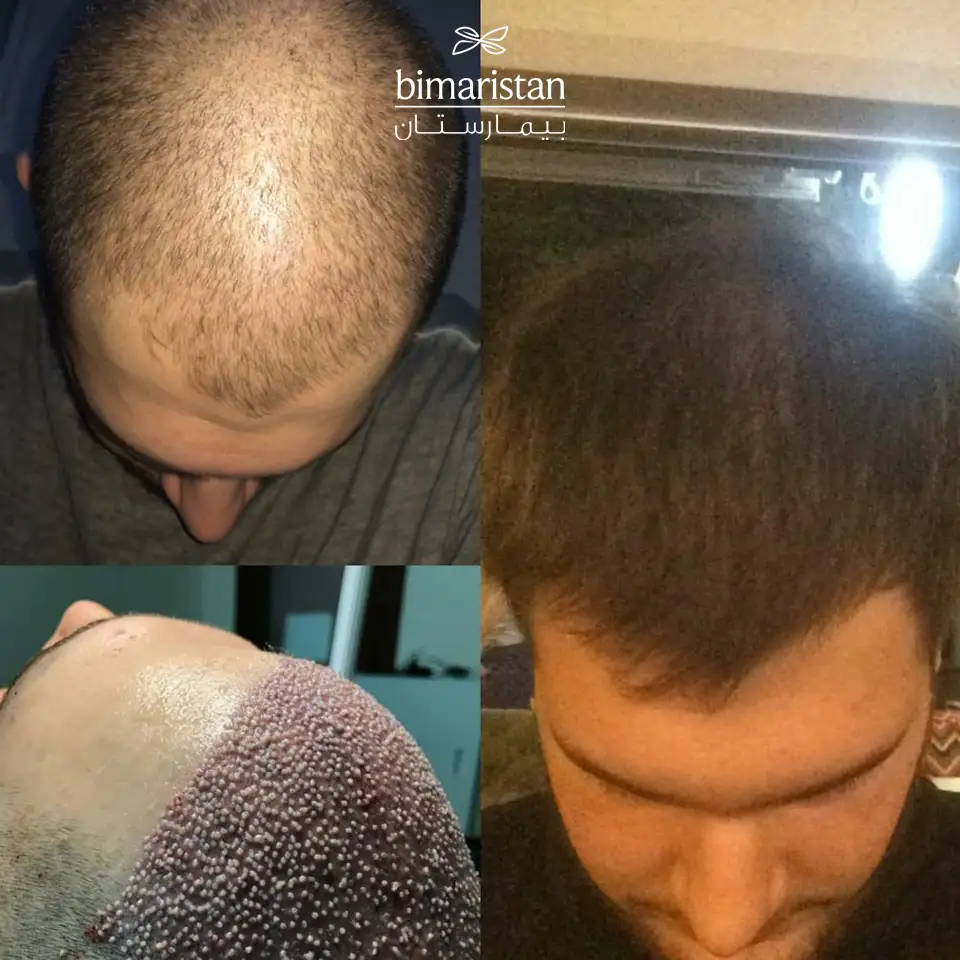 Hair Transplant Customer Picture 2