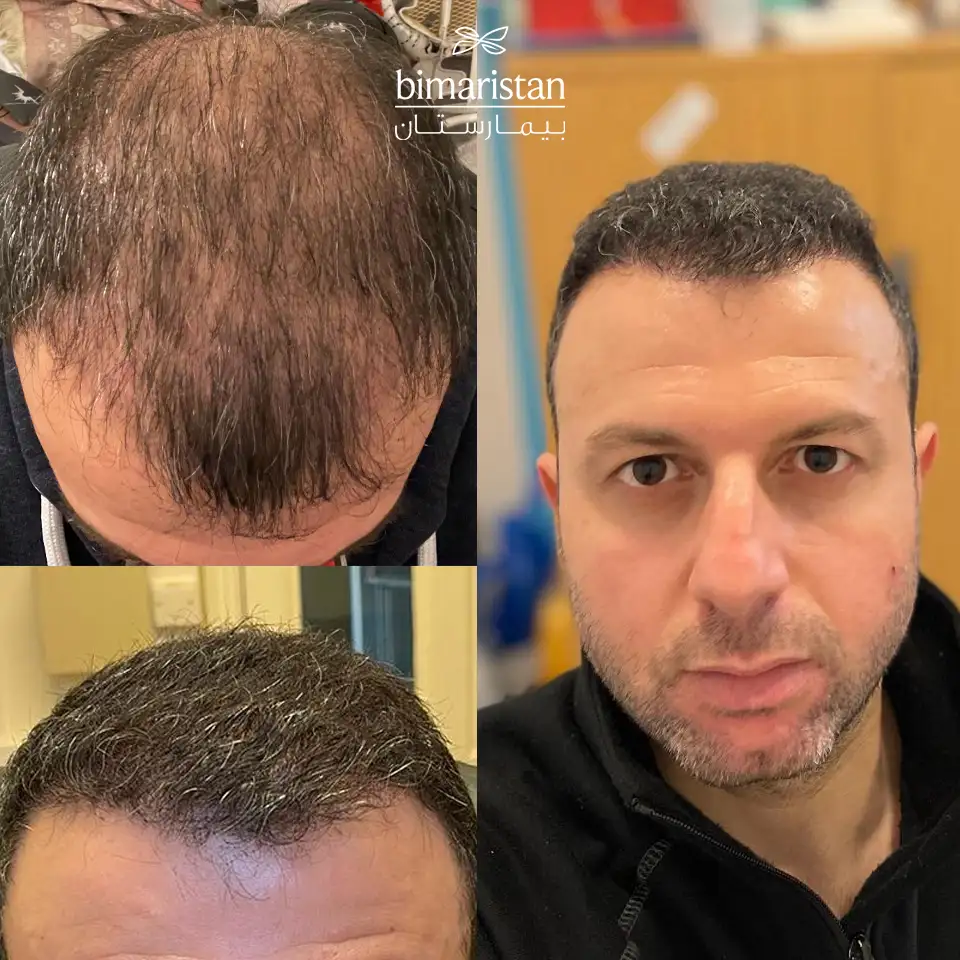 Hair Transplant Customer Picture 3