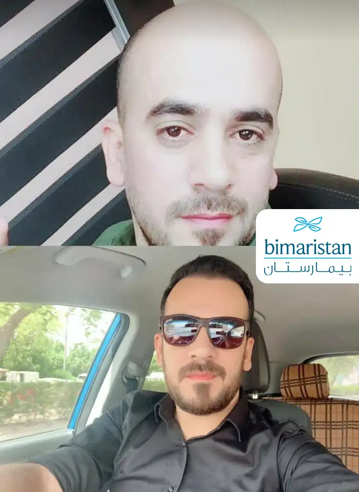 Hair Transplant Customer Picture 5
