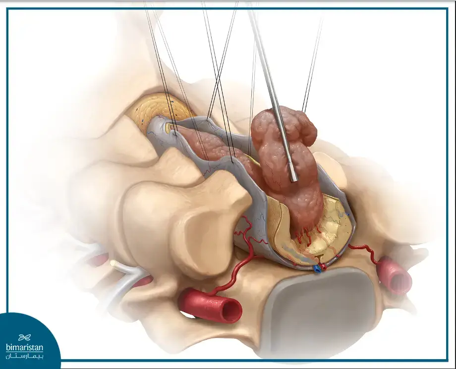 Spinal Cord Tumor Resection Surgery In Neurosurgery Centers In Turkey