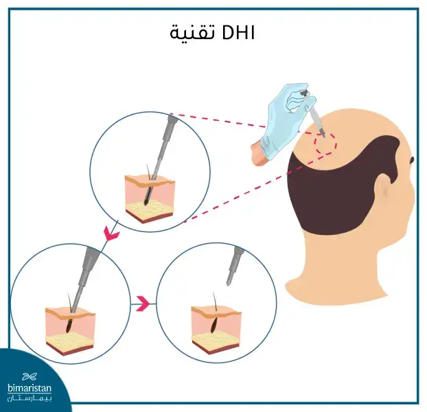 كيفية إجراء تقنية Dhi لزراعة الشعر