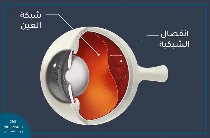 انفصال الشبكية من أهم أمراض العيون في تركيا