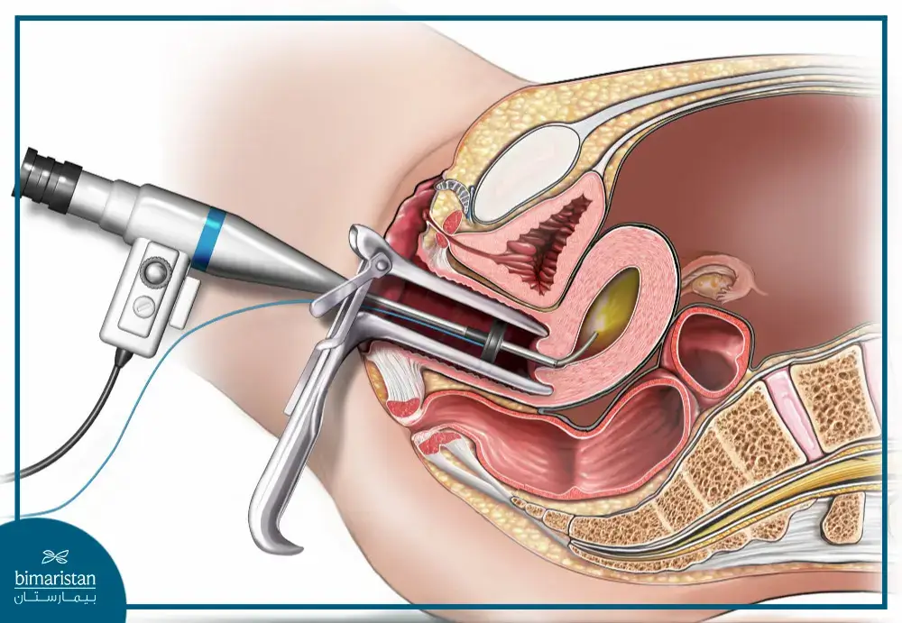 Hysteroscopy Procedure In Gynecology Obstetrics Centers