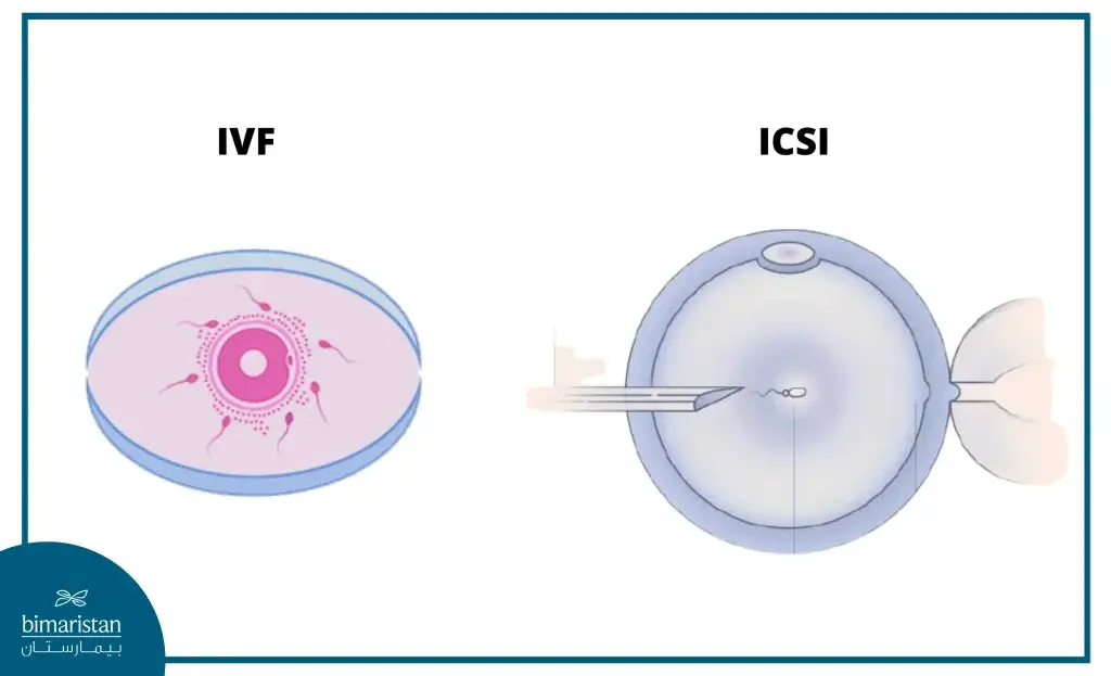 Difference Between In Vitro Fertilization And Icsi