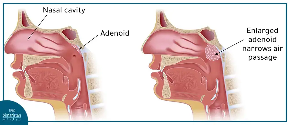 Adenoidectomy In Otorhinolaryngology Centers