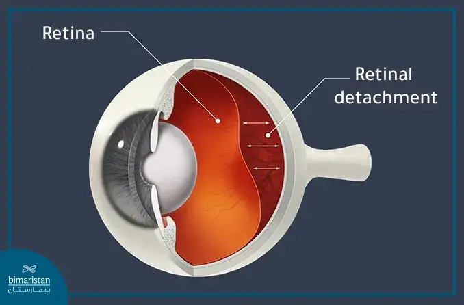 Retinal Detachment Is One Of The Most Important Eye Diseases In Turkey.