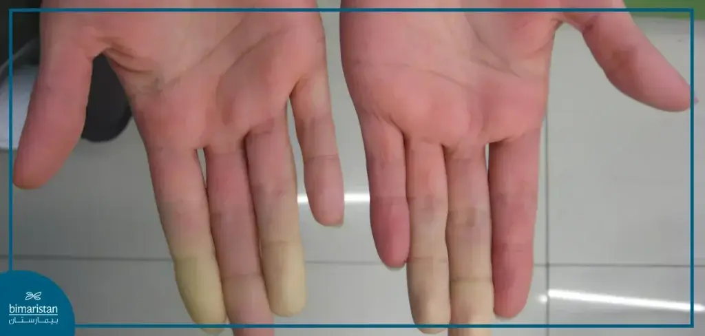 Raynaud'S Syndrome