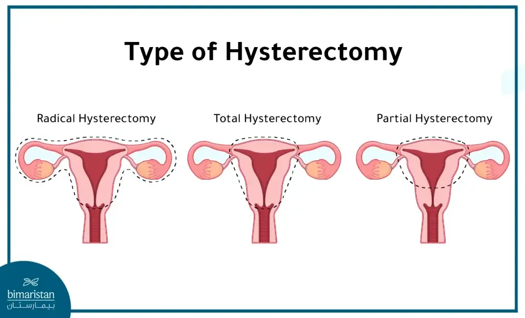 Types Of Hysterectomy Surgeries
